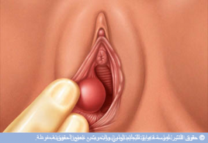 علاج غدة بارثولين بدون جراحه - علاج كيسة بارثولين بطرق طبيعية 5976 1