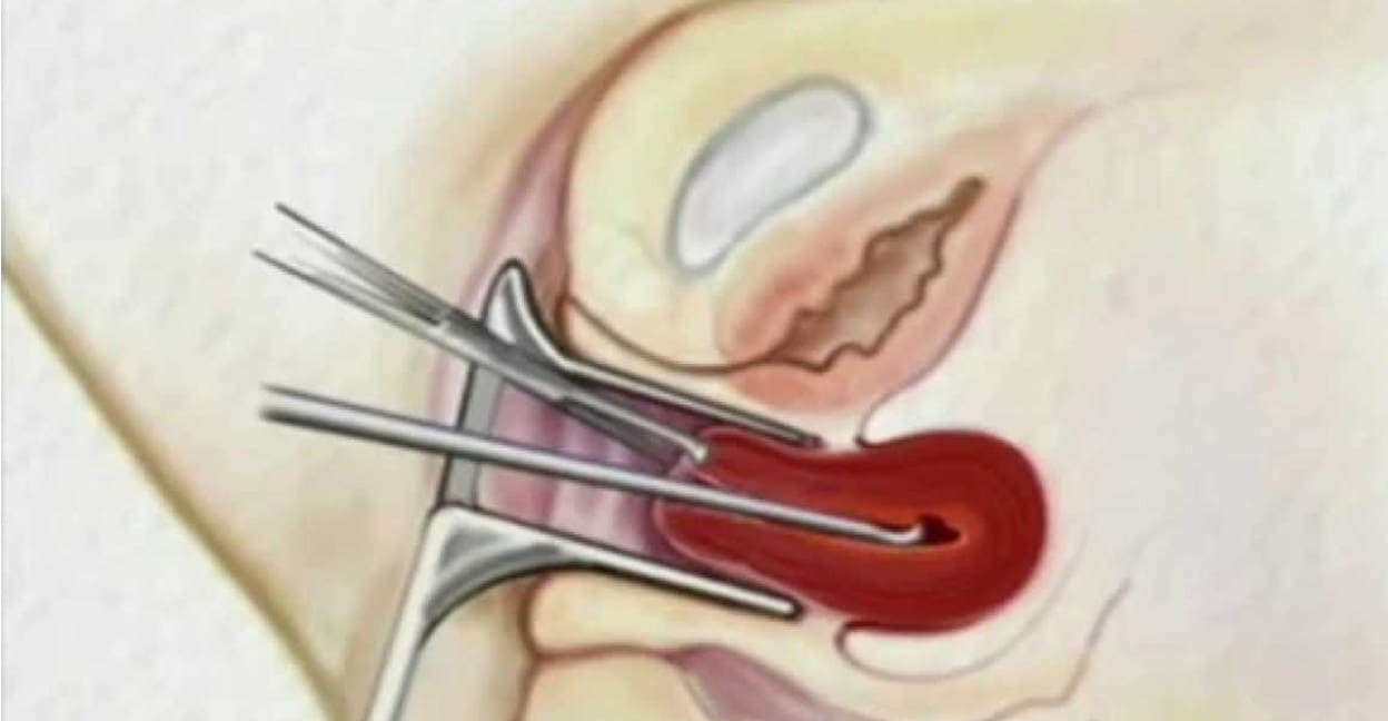 عملية الكورتاج بالصور , شوف معانا احدث صور للكورتاج