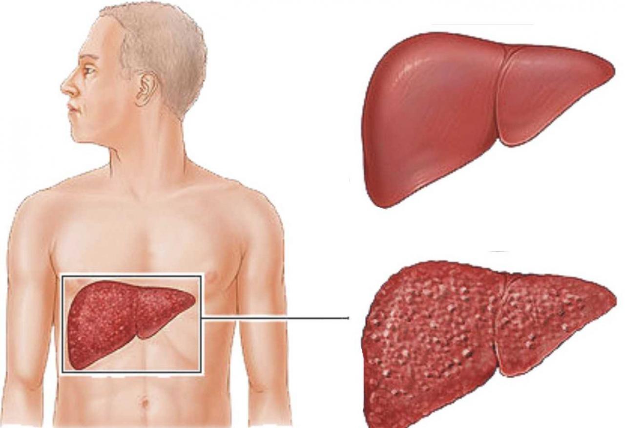 علاج التهاب الكبد c بالاعشاب , كيفيه الوقايه من التهاب الكبد بالاعشاب