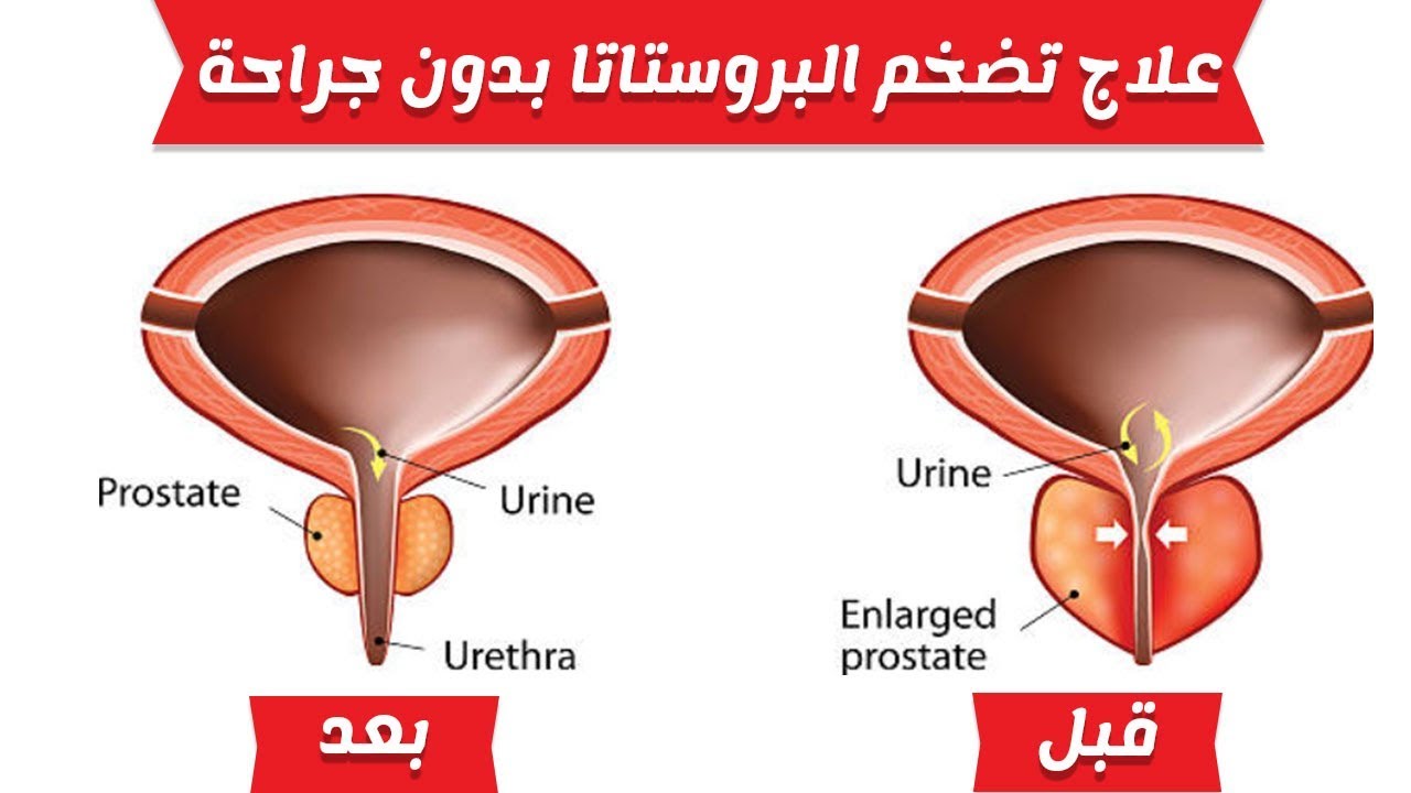 علاج تضخم البروستاتا , افضل واسرع علاج لتضخم البروستاتا