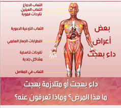 علاج مرض بهجت- وما هي طرق التعامل معه 12114 3