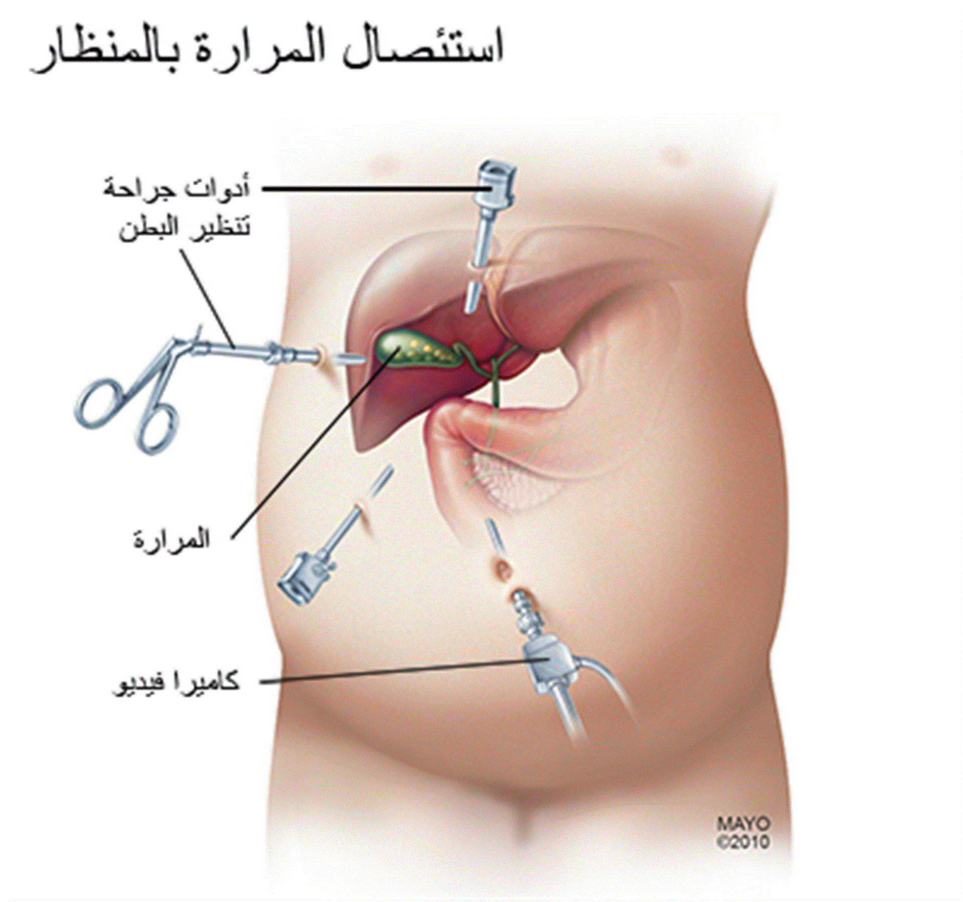 استئصال المرارة بالمنظار - ايهما الافضل استئصال المرارة بالجراحة او المنظار 4510 1