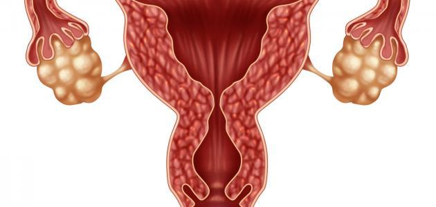 علاج تكيس المبايض بالماء – علاج ليس له مثيل من تجربتي