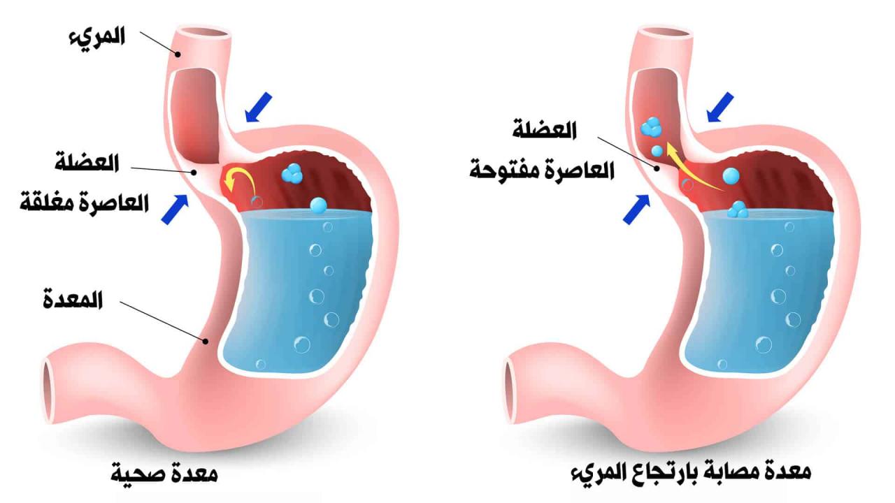 علاج الارتداد المريئي بالاعشاب , افضل واحلى علاج للارتداد المريئى بالاعشاب