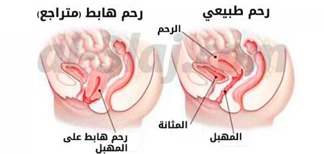 علاج نزول الرحم , اسباب نزول الرحم وطرق علاجه