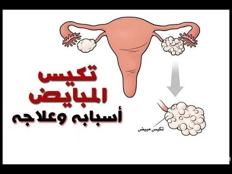 كيس ميه على المبيض , اسباب وعلاج تكيس المبايض