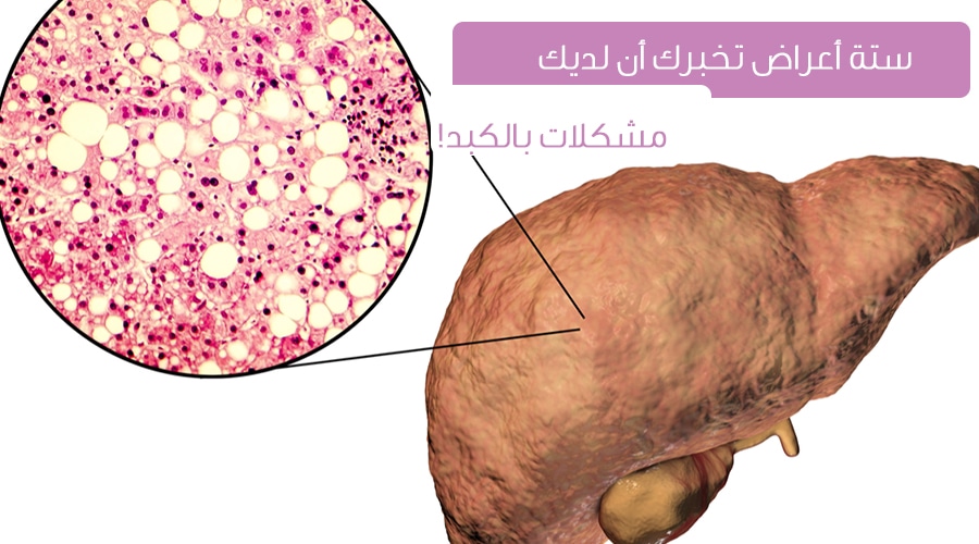 امراض الكبد واعراضها , تعرف على طرق العلاج