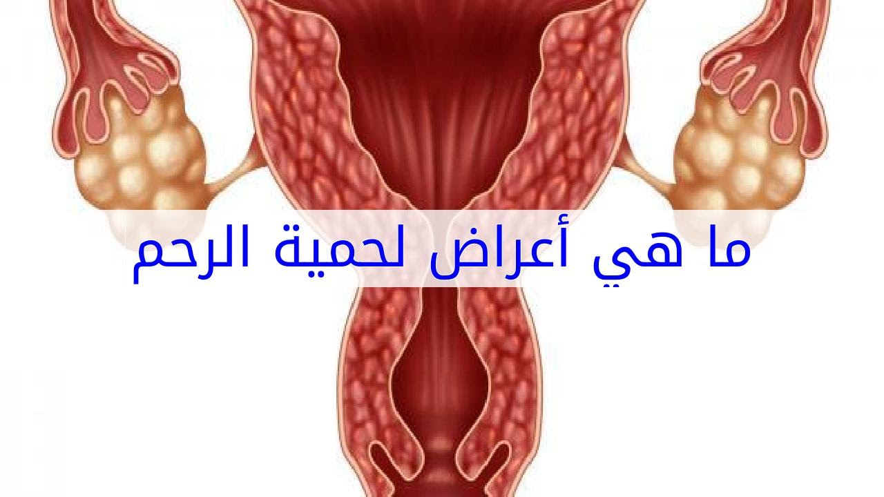 اعراض اللحمية في الرحم , اسباب ظهور اللحمية داخل الرحم