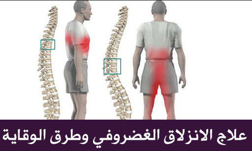 علاج الانزلاق الغضروفي بالاعشاب , كيفية علاج مرض الانزلاق الغضروفي بالاعشاب