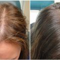 3785 2 علاج الشعر بالبلازما - فوائد واضرار الحقن بالبلازما للشعر مزون سهير