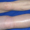 6307 2 جلطة الساق وعلاجها - علاجات فعالة لجلطة الساق شجون موسى