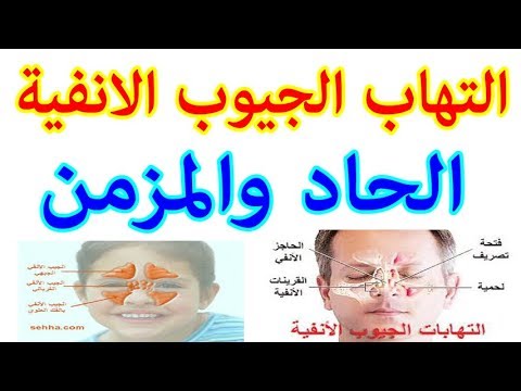 حبوب الجيوب الانفية , اقوى علاج للجيوب الانفية