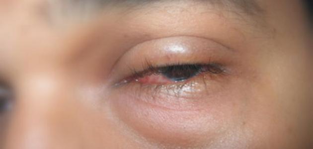 3587 1 علاج انتفاخ العين علاج انتفاخ تحت العين بالليزر - علاج العين وانتفاخها غدير مطلق