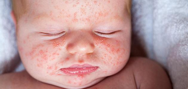 علاج حساسية خدود الأطفال حكة في الوجه - اسباب حكة في الوجه صفاء منير