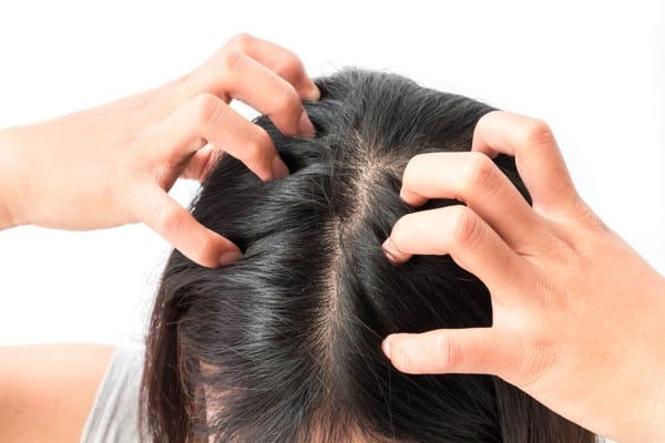 12369 2 علاج قشرة الشعر بالاعشاب - كيفية التخلص من القشرة فى الشعر شجون موسى