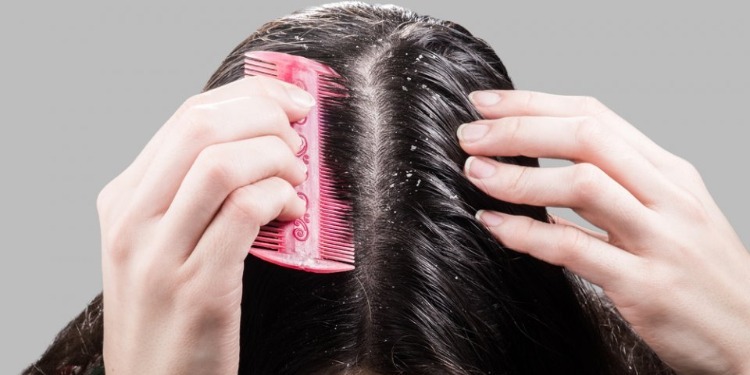12369 علاج قشرة الشعر بالاعشاب - كيفية التخلص من القشرة فى الشعر شجون موسى