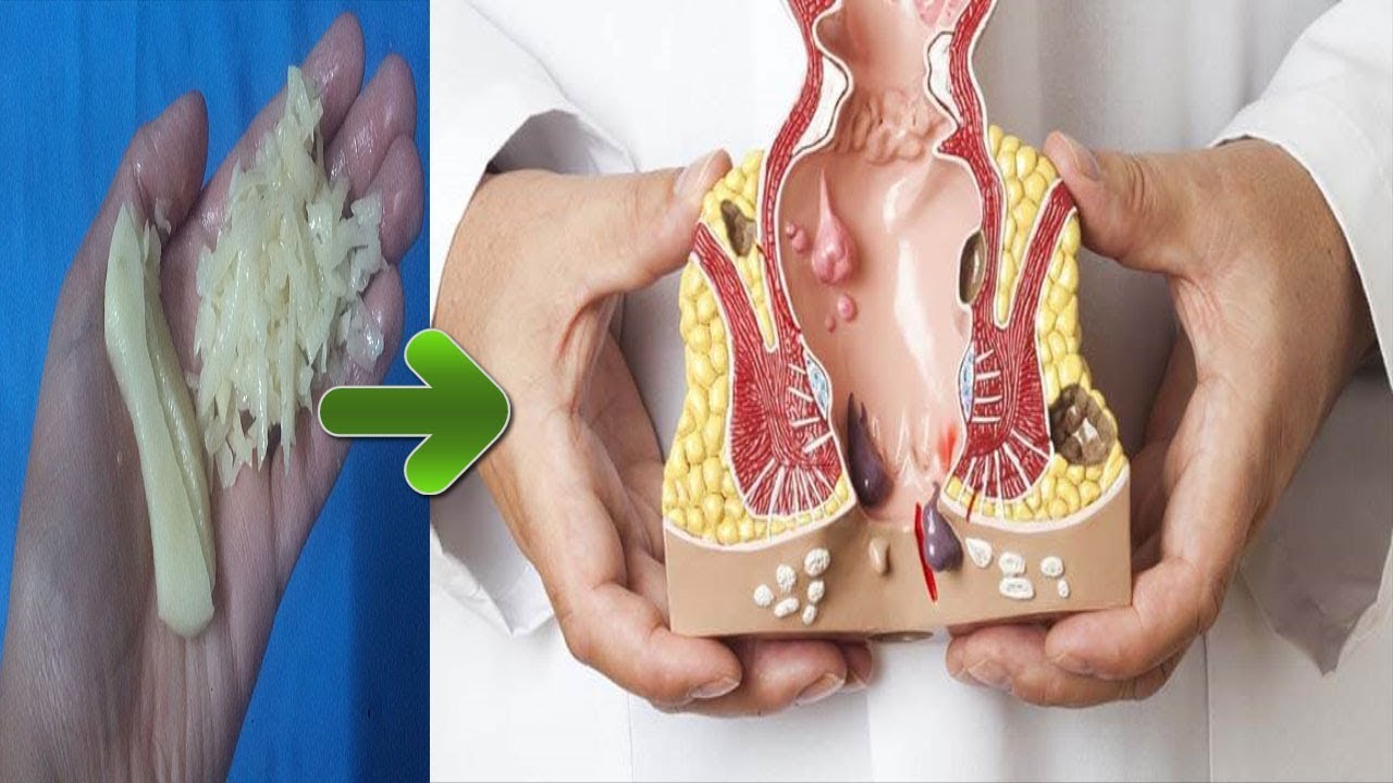 علاج مرض البواسير بالاعشاب , كيفيه الوقايه من مرض البواسير