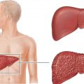 13265 2 علاج التهاب الكبد C بالاعشاب - كيفيه الوقايه من التهاب الكبد بالاعشاب يسرا شوقي