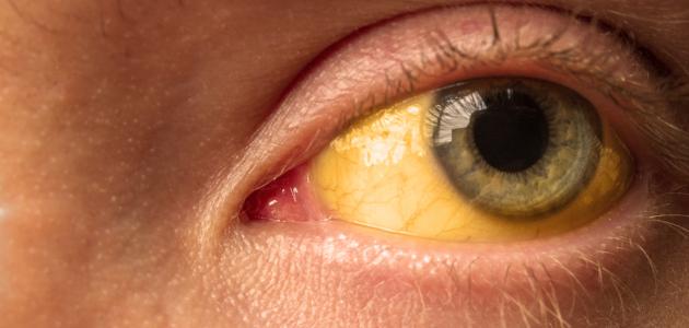 علاج صفار العين , وصفات علاجية في المنزل - افضل جديد