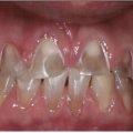 19359 1 اسباب تاكل الاسنان عند الكبار،تعرف على اسباب تاكل الاسنان و كيف يمكن منعه رهف
