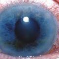 19508 1 علاج المياه الزرقاء على العين،افضل علاج للمياه الزرقاء المتواجدة في العين طائش